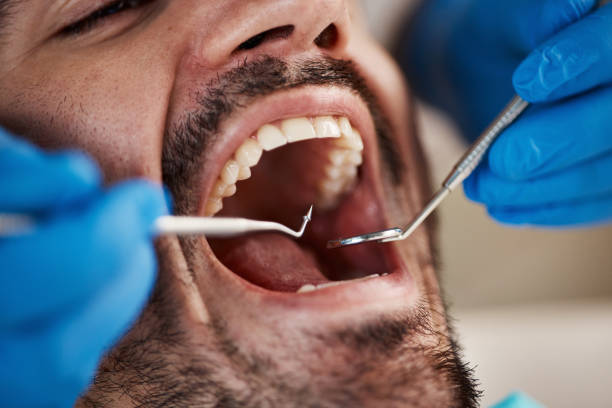 Best Emergency Tooth Extraction in Spring Valley, WI